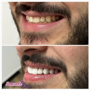 Lente de resina na Vila Formosa - Dra. Amanha Bim