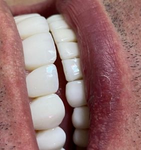 Lente dental em resina na Vila Formosa - Dra. Amanha Bim