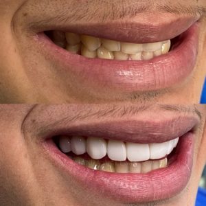 Preço de Lente dental em resina na Vila Formosa - Dra. Amanha Bim